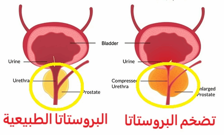البروستاتا